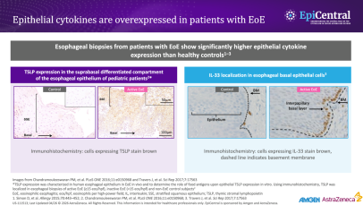 Histological images showing TSLP and IL-33 expression in oesophageal epithelium of patients with EoE.