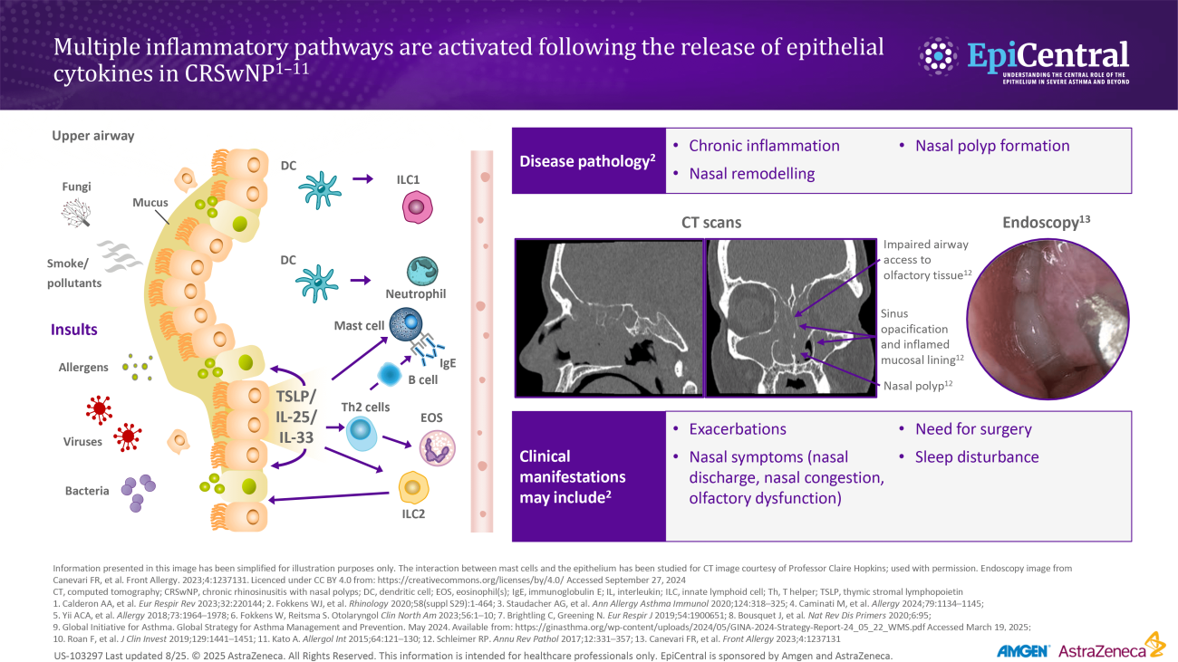 Multiple inflammatory pathways are activated following the release of epithelial cytokines in CRSwNP