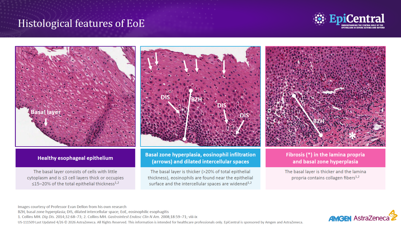 Histological features of EoE. Three frames showing histological features in a healthy oesophageal epithelium, basal zone hyperplasia with eosinophil infiltration and dilated intercellular spaces, and fibrosis in the lamina propria.